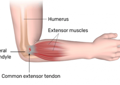 ELBOW PAIN TREATMENT_12