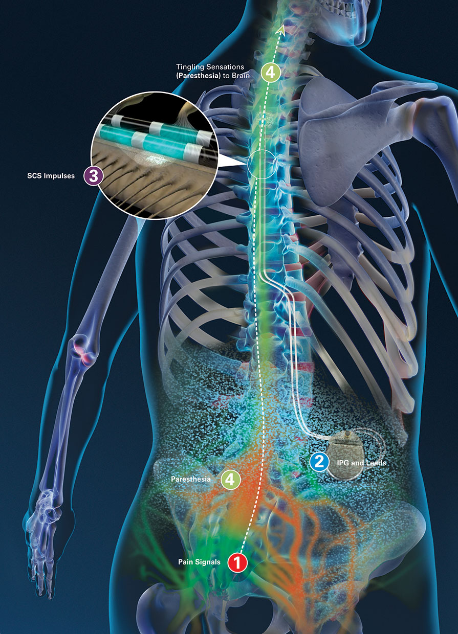 Learn How Spinal Cord Stimulators Provide Pain Relief After Failed Back  Surgery: Glaser Pain Relief Center: Interventional Pain Management  Specialists