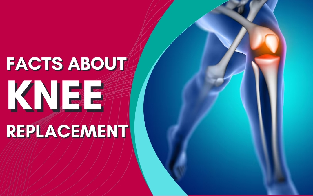 Facts About Knee Replacement